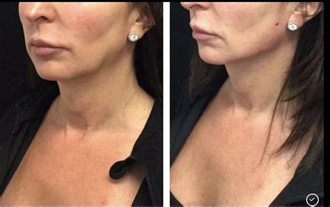Before And After Photo Hilton Head Plastic Surgery And Medspa