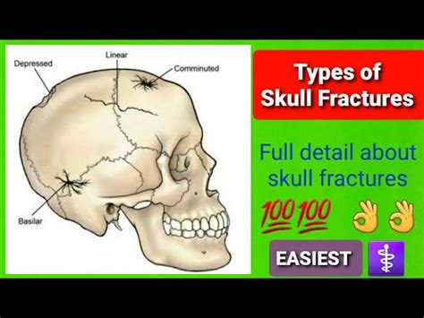 Types Of Skull Fracture