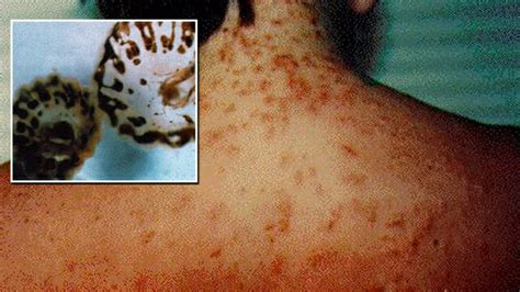 Symptoms of swimmer's itch include tingling or burning skin, small reddish pimples and tiny blisters. Sea lice break out in Florida - experts issue warning