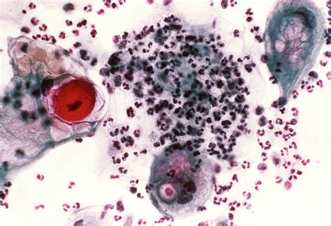 Lm Of Cervical Smear Showing Effects Of Radiation Photograph By Science