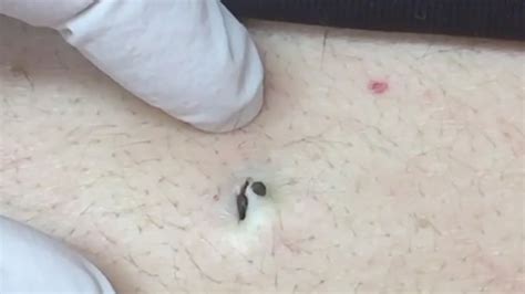 Pimple popper pop a whole row of blackheads on a teenager's nose in a new video. Dr Pimple Popper extracting this blackhead the size of a ...
