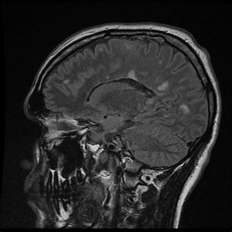Multiple sclerosis (ms), also known as encephalomyelitis disseminata, is a demyelinating disease in which the insulating covers of nerve cells in the brain and spinal cord are damaged. Esclerosis-Multiple-MSblog: Utilidad de la MRI en el diagnostico diferencial en Esclerosis Multiple