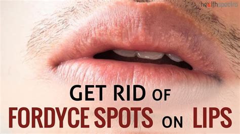 How To Get Rid Of Fordyce Spots On Lip Line