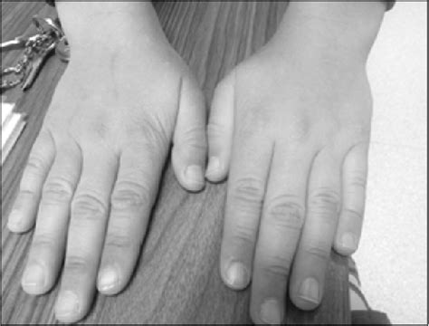 Cyanosis In The Patients Right And Left Fingers Download Scientific