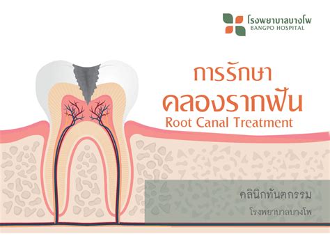 การรักษาคลองรากฟัน (Root Canal Treatment) - โรงพยาบาลบางโพ