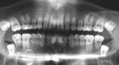 Characteristically Short And Blunt Roots In A Patient 16 Years With Download Scientific