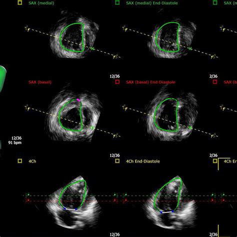 Three Dimensional Echocardiography Of Right Ventricular Volumes And