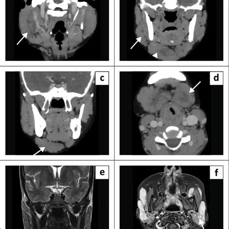 Coronal And Axial Contrast Enhanced Ct Images Of The Face Show Enlarged