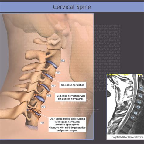 Cervical Spine Trialexhibits Inc