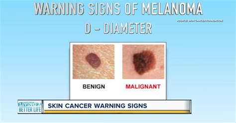 Melanoma Skin Cancer Signs And Symptoms Steve