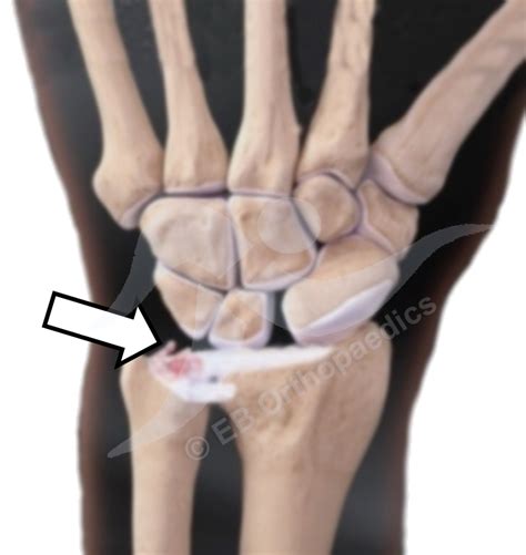 Mit jelent a (z) tfcc? Orthopaedic & Trauma Surgeon - Wrist - TFCC injury