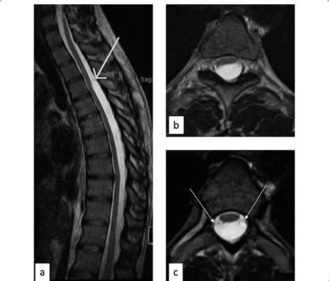 Mri Of The Arachnoid Cyst In Dorsal Spine T2w Sagittal A And Axial