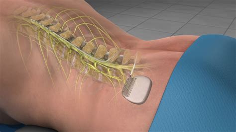 Spinal Cord Stimulator Implant Trial And Surgery Uses And Complications