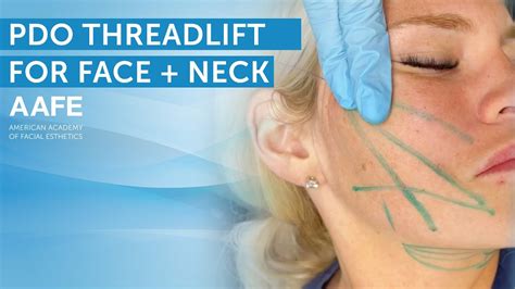 Non Surgical Face And Neck Lift With Pdo Lifting Threads Aafe Youtube