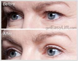 Is a top flight eyelid surgeon in washington dc and eyes looking sad, morose or simply not attractive can be disconcerting. EasyLift Instantly Lifts Drooping Eyelids Without Eyelid ...