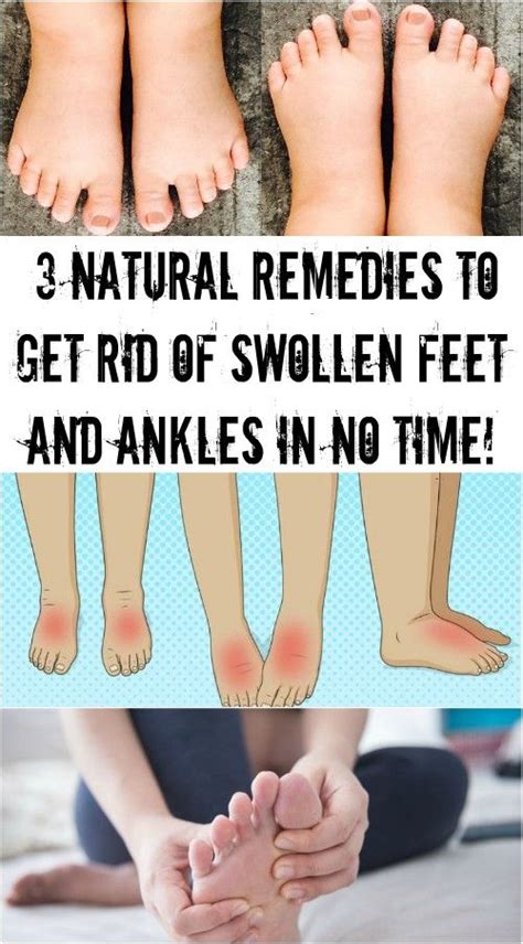 3 Natural Remedies To Get Rid Of Swollen Feet And Ankles In No Time Swollen Ankles Natural