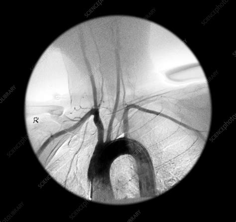 Aortic Arch Angiogram Stock Image P2060497 Science Photo Library