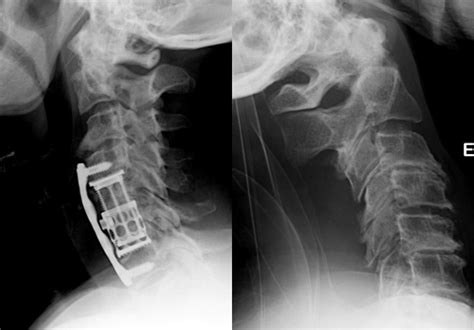 All About Cervical Spine Surgery Center Spine India