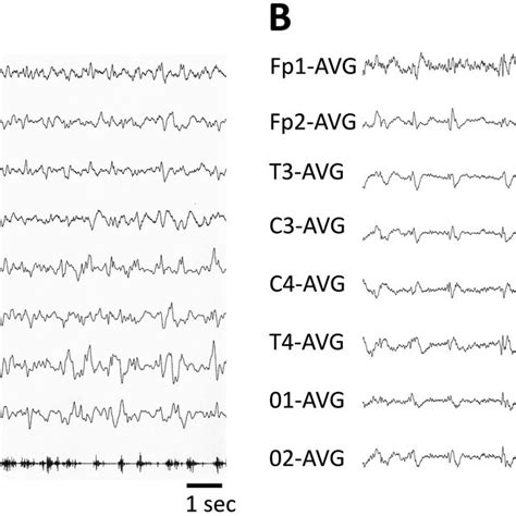 Representative Eeg Epochs Showing Left‐sided Lateralized Periodic