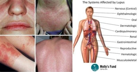 lupus diet tips | Lupus flare up, Lupus diet, Lupus The symptoms get worse and just don't go away.