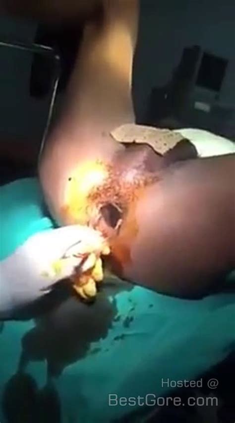 Surgical Removal Of Fanta Can From Anus Of Gay Man In