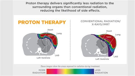 Proton Therapy For Treating Left Sided Breast Cancer Plays A Crucial