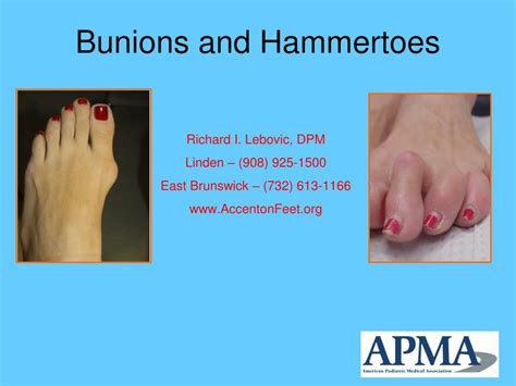 Ppt Bunions And Hammertoes Powerpoint Presentation Free Download