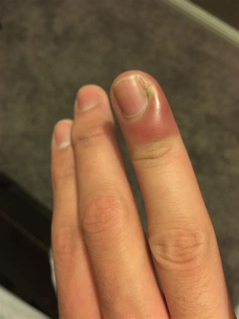 Finger Swollen For 2 Weeks And Is Not Healing Should I Be Concerned