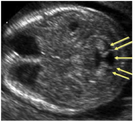 Figure 1 From Accuracy In Antenatal Ultrasound In Diagnosis Of