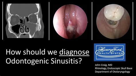 Diagnosing Odontogenic Sinusitis International Consensus Youtube