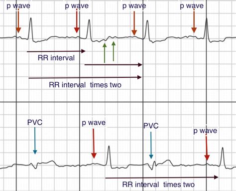 Sustained Atrial Fibrillation Or Not The Vagaries And Inaccuracies Of