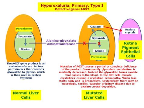 Hyperoxaluria Primary Type I Hereditary Ocular Diseases