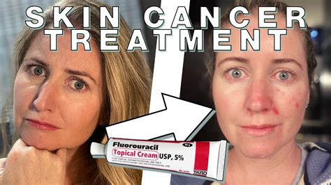 Chantelles Fluorouracil Skin Cancer Treatment Skin Deep Youtube