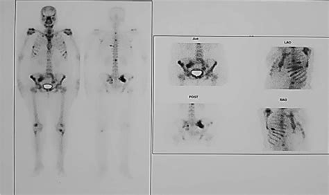 Bone Scan Represents Multiple Metastatic Lesions Involving Bilateral