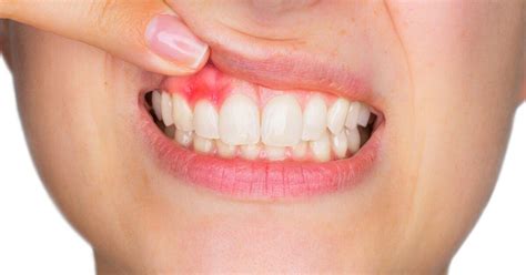 Gum Disease Prevention And Cure