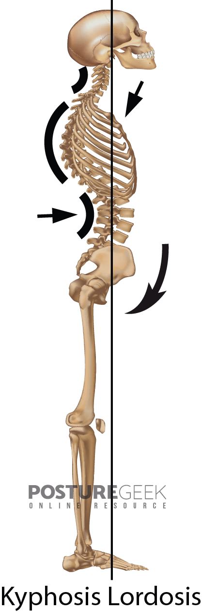 Kyphosis Lordosis Posture Posture Geek