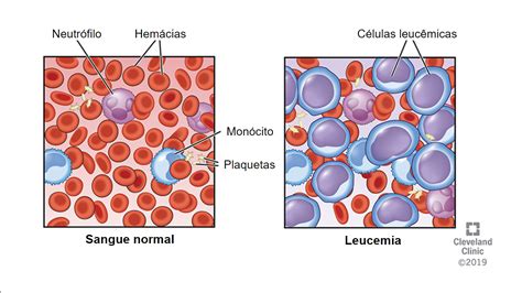 Leucemias O Que S O Origem E Tipos De C Nceres Do Sangue Sanar Medicina
