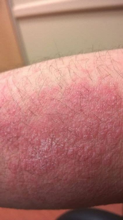 Very Itchy Rash Possible Dh
