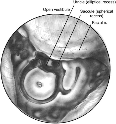 Endolymphatic Sac Shunt Labyrinthectomy And Vestibular Nerve Section