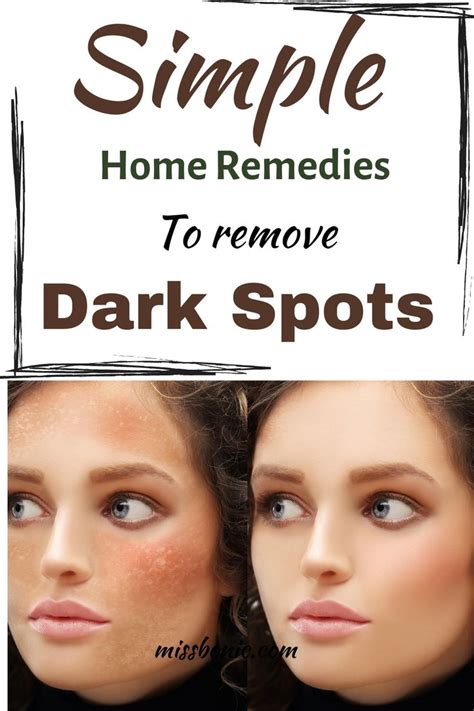 Simple Home Remedies To Remove Dark Spots Remove Dark Spots Dark