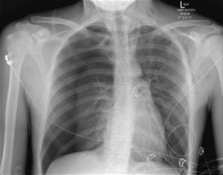 Tension Pneumothorax Radiology Case Radiopaedia Org