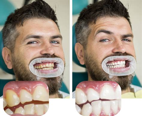 We did not find results for: ZOOM! Teeth Whitening Treatment | La Mesa, CA | Cardinal ...