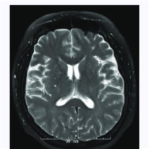 Mri Of The Brain Showing Abnormal Increase Of T2 Flair Signal Involving