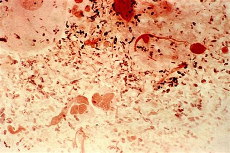 Untreatable Gonorrhea On The Rise Microbiology