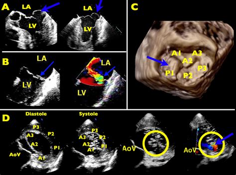 Mitral Valve Repair An Echocardiographic Review Part 2 Journal Of