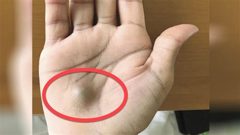 A Man Found This Strange Lump On His Palm Then A Scan Revealed The True