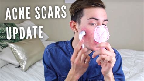 ACNE SCARS UPDATE 