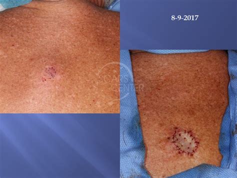 Melanoma In Situ Of Back Skin Cancer And Reconstructive Surgery Center
