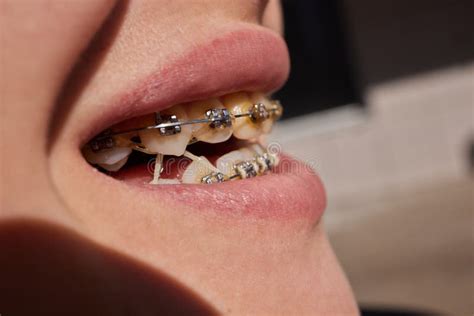 Close Up To A Young Caucasian Lady S Mouth Wearing Braces Or Brackets Her Orthodontic Treatment