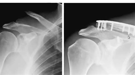 Distal Clavicle Fracture